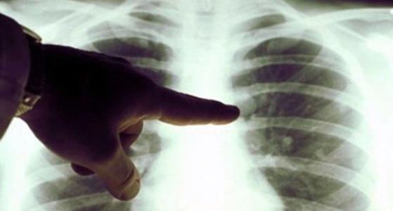 E-cigarette lung disease